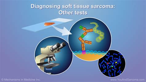 Image result for Soft Tissue Sarcoma Hand
