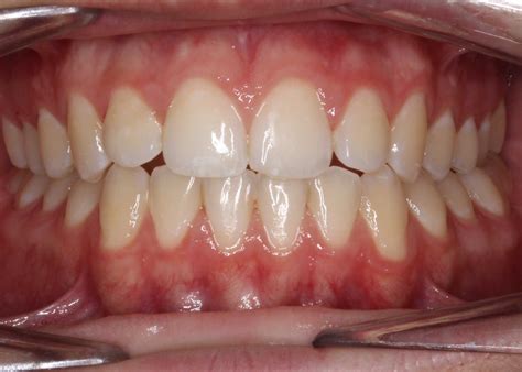 Image result for Crossbite Treatment Options