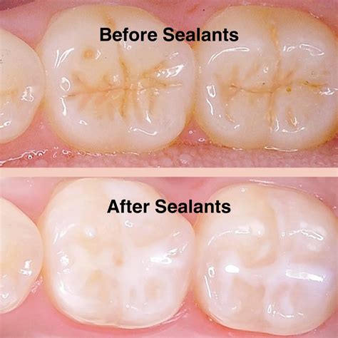 Sealants For Teeth