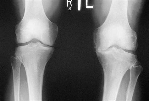 Image:X-Ray of the Knee in Osteoarthritis-MSD Manual Professional Edition