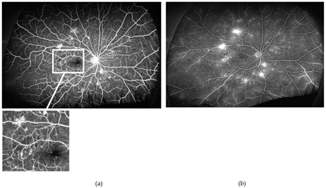 Retinal Ischaemia in Diabetic Retinopathy: Understanding and Overcoming ...