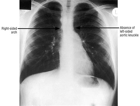 Right sided aortic arch in children with persistent respiratory symptoms | The BMJ