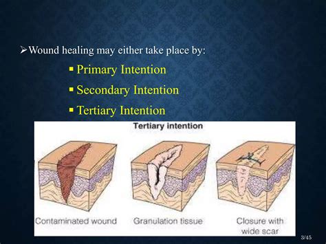 Wound healing in Perio - Dr. Malvika Thakur | PPTX