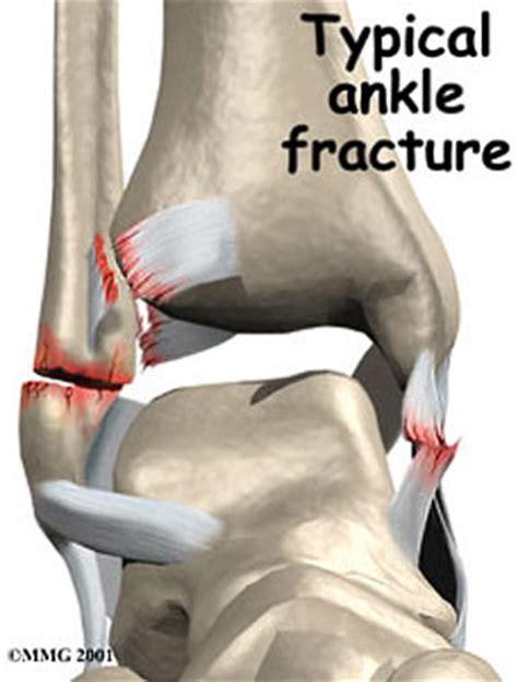 Ankle Fracture (Broken Ankle) Recovery Time, Treatment, Symptoms & Causes