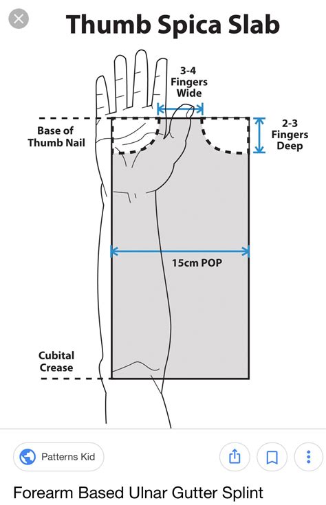 Radial Gutter Splint Pattern