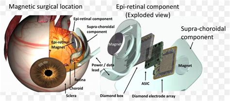 Image result for Visual Prosthesis Implant