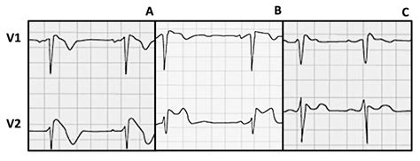 Brugada Syndrome and Exercise: Is It Time for a Paradigm Change?