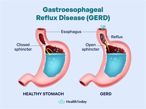 GERD Symptoms at Night | How to Sleep With GERD? - HealthToday