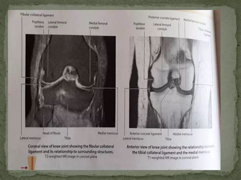 Anatomy and imaging of knee joint | PPTX