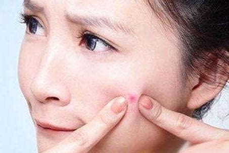 满脸痘痘，该使用什么用的面膜？