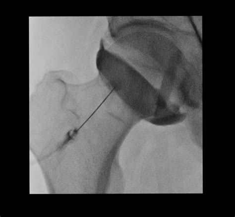 Image result for Back Arthrogram Technique