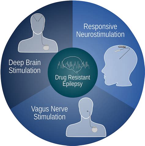 Neurostimulation treatments for epilepsy: Deep brain stimulation, responsive neurostimulation ...