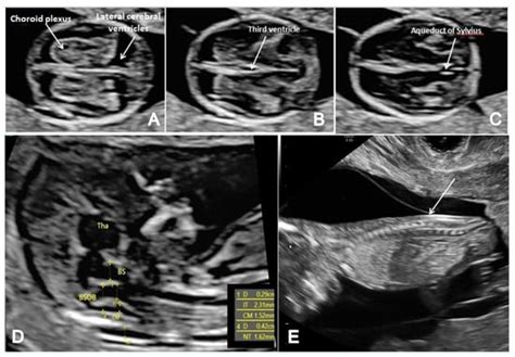 First Trimester Ultrasound Detection of Fetal Central Nervous System ...