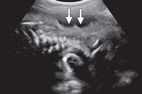 Bildergebnis für umbilical cord abnormalities ultrasound