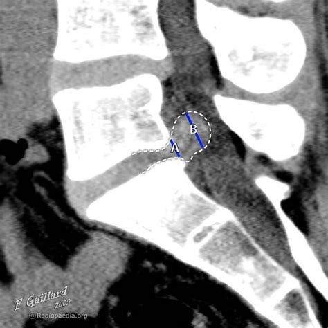 Image result for Foraminal Disc Extrusion