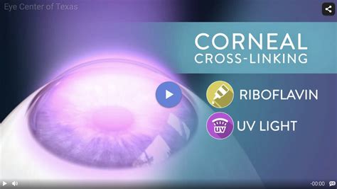 Corneal Cross-Linking Surgery | Eye Center of Texas