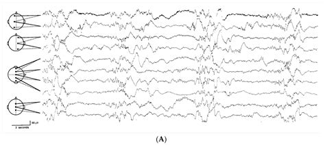 Sleep Disturbances in Newborns
