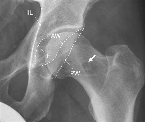 Cam Type Femoroacetabular Impingement Radiology at Eileen Towner blog