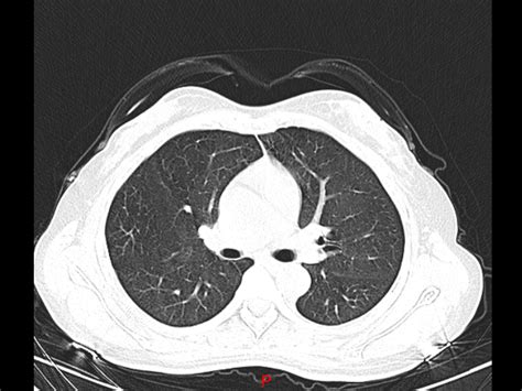 肺部CT怎么看？读2遍，会看气管和肺血管就入门了 谨记|糖尿病患者|糖尿病|病情|锻炼|血
