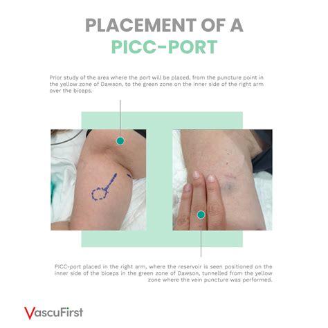 Porta Catheter Placement