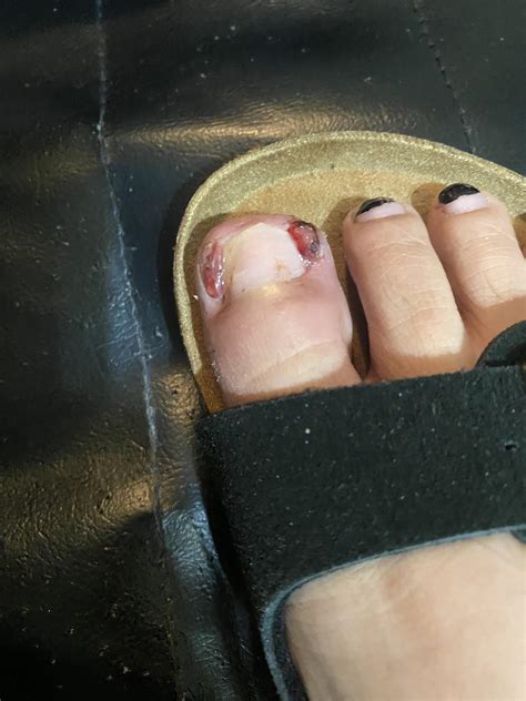 Ingrown toenail granuloma infection ?? : r/Ingrown_Toenails