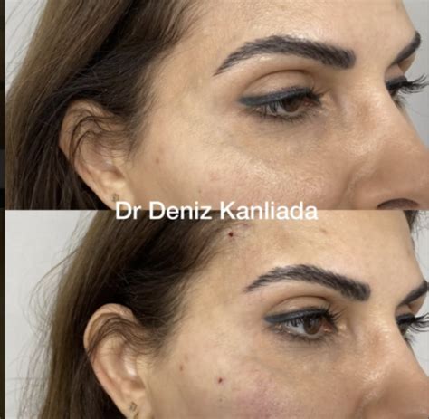 Image result for Fox Eye Thread Lift Procedure