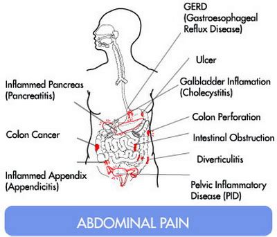 Image result for Appendix Pain Area