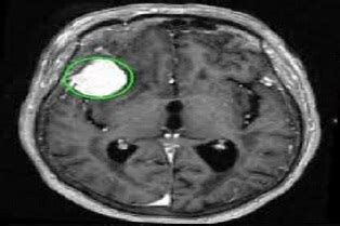 Advancing Brain Tumor Research: Exploring Causes, Treatments, and Hope ...