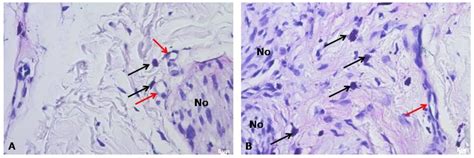Traumatic Neuroma of the Hard Palate Mimicking a Small Salivary Gland ...