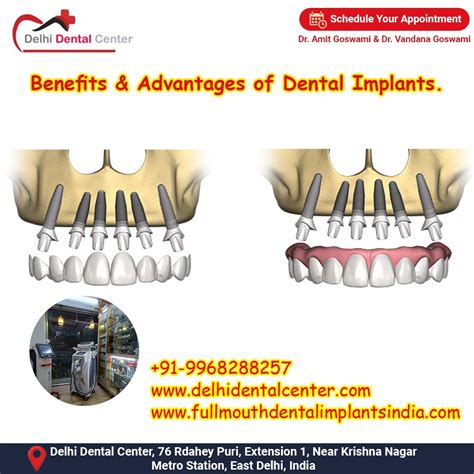 Image result for Different Types of Teeth Implants