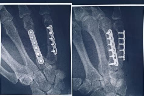 Metacarpal Fracture 5th