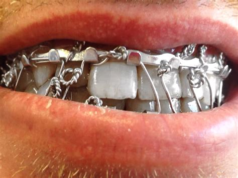 Broken Jaw Wired Shut