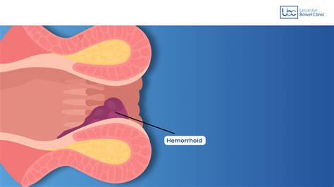 Banding of Haemorrhoids(Piles) - Leicester Bowel Clinic