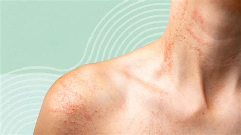 Rashes: Symptoms, Treatment, and Prevention