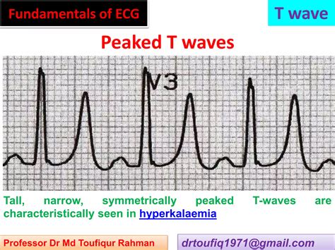 Approach to a patient with T wave abnormality in ECG | PPSX