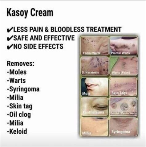Buy Kasoy Cream Remove Moles, Warts, Keloid, Oil Clog Skin Tag More ...