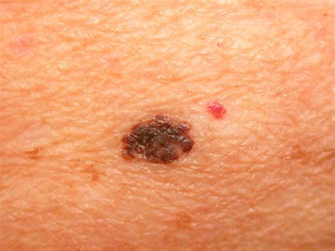 Early Stage Melanoma Pictures Melanomas Detected During Digital