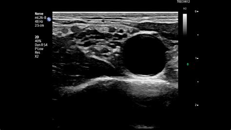 Philips-Flash-Ultrasound-System-5100-Point-of-Care