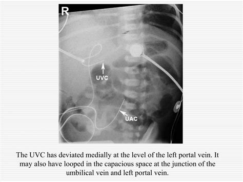 Neonatal Umbilical Venous Catherization Radiology | PPT