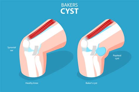 What is a Baker's Cyst?