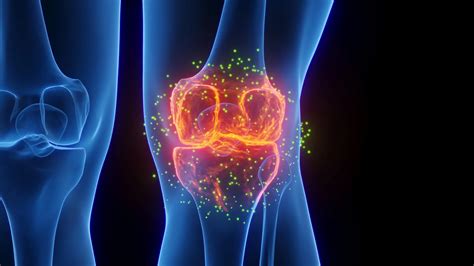 Massive review suggests exercise may do little for osteoarthritis pain | ScienceDaily