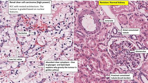 Renal Cell Carcinoma Staging - Face Surgery