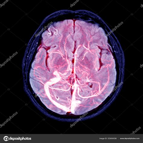 Magnetic resonance venography(MRV) Brain of veins in human head. — Stock Photo © Richmanphoto ...