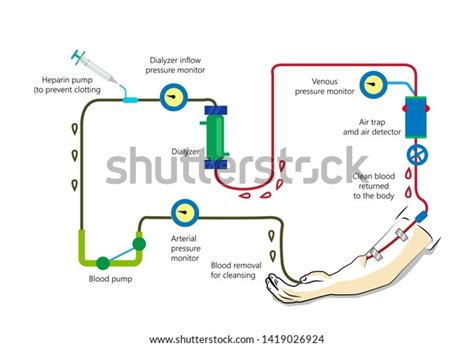 Image result for Dialysis Procedure Step by Step