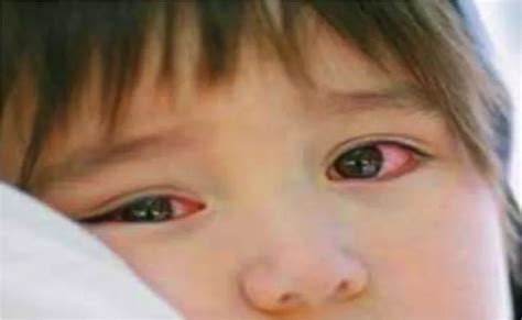 时刻注意孩子眼睛，这里有一份眼科医生为你整理的指南_宝宝