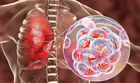 Ultra-low dose CT aids pneumonia diagnosis in immunocompromised ...