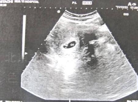 孕囊在长但无胎芽胎心怎么回事 这四个原因需注意