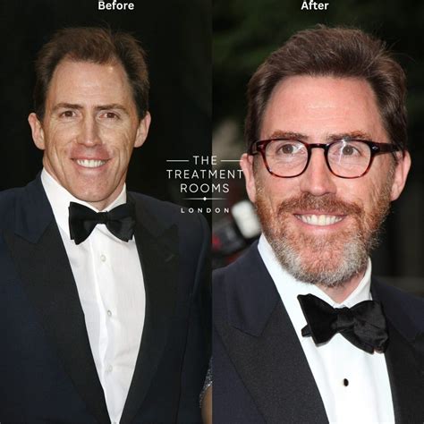 Celebrity Hair Transplants: Full Before and After Analysis