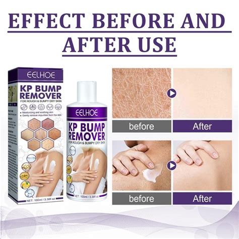 Keratosis Pilaris Repair Cream Exfoliating For India | Ubuy