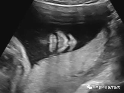 胎儿唇腭裂的影像学特征分析